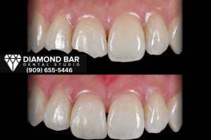 dental bonding Diamond Bar
