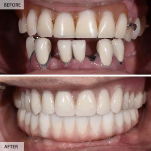 dental implants Diamond Bar